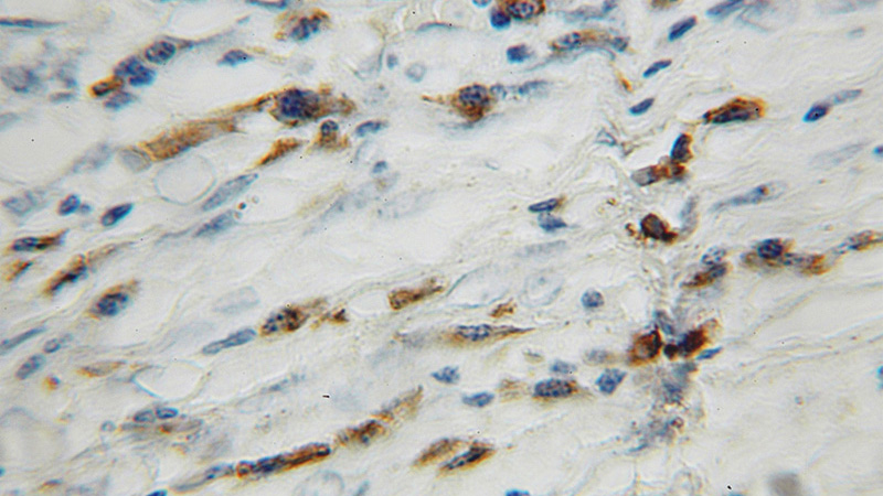 Immunohistochemical of paraffin-embedded human lung cancer using Catalog No:110824(GAGE1 antibody) at dilution of 1:100 (under 10x lens)