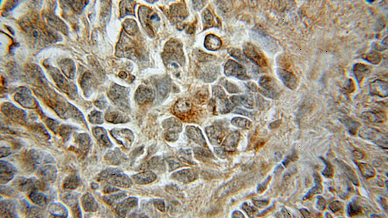 Immunohistochemical of paraffin-embedded human medulloblastoma using Catalog No:114363(PTK2B antibody) at dilution of 1:50 (under 10x lens)
