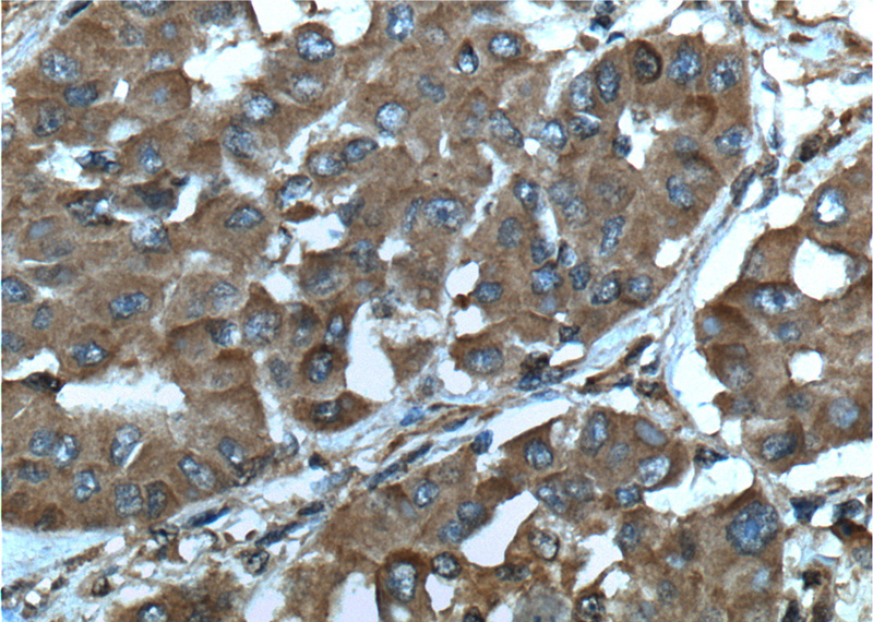 Immunohistochemistry of paraffin-embedded human liver cancer tissue slide using Catalog No:107586(SGTA Antibody) at dilution of 1:200 (under 40x lens).