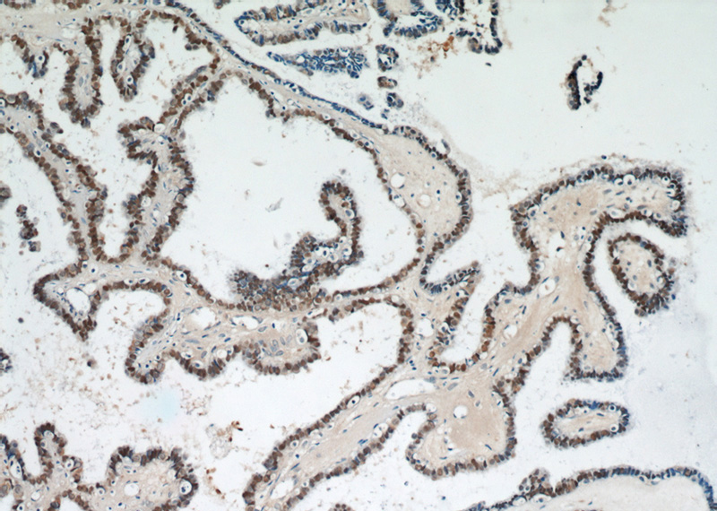 Immunohistochemical of paraffin-embedded human ovary tumor using Catalog No:113572(pan-PAX antibody) at dilution of 1:50 (under 10x lens)