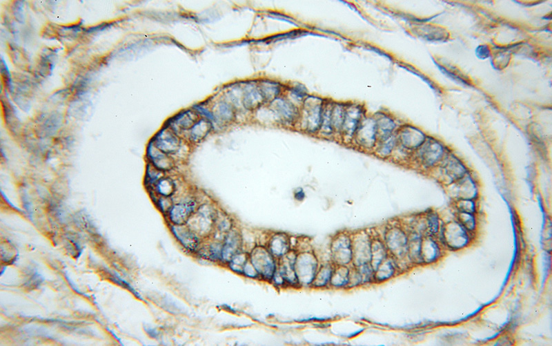 Immunohistochemical of paraffin-embedded human pancreas cancer using Catalog No:115823(SUGT1 antibody) at dilution of 1:50 (under 10x lens)