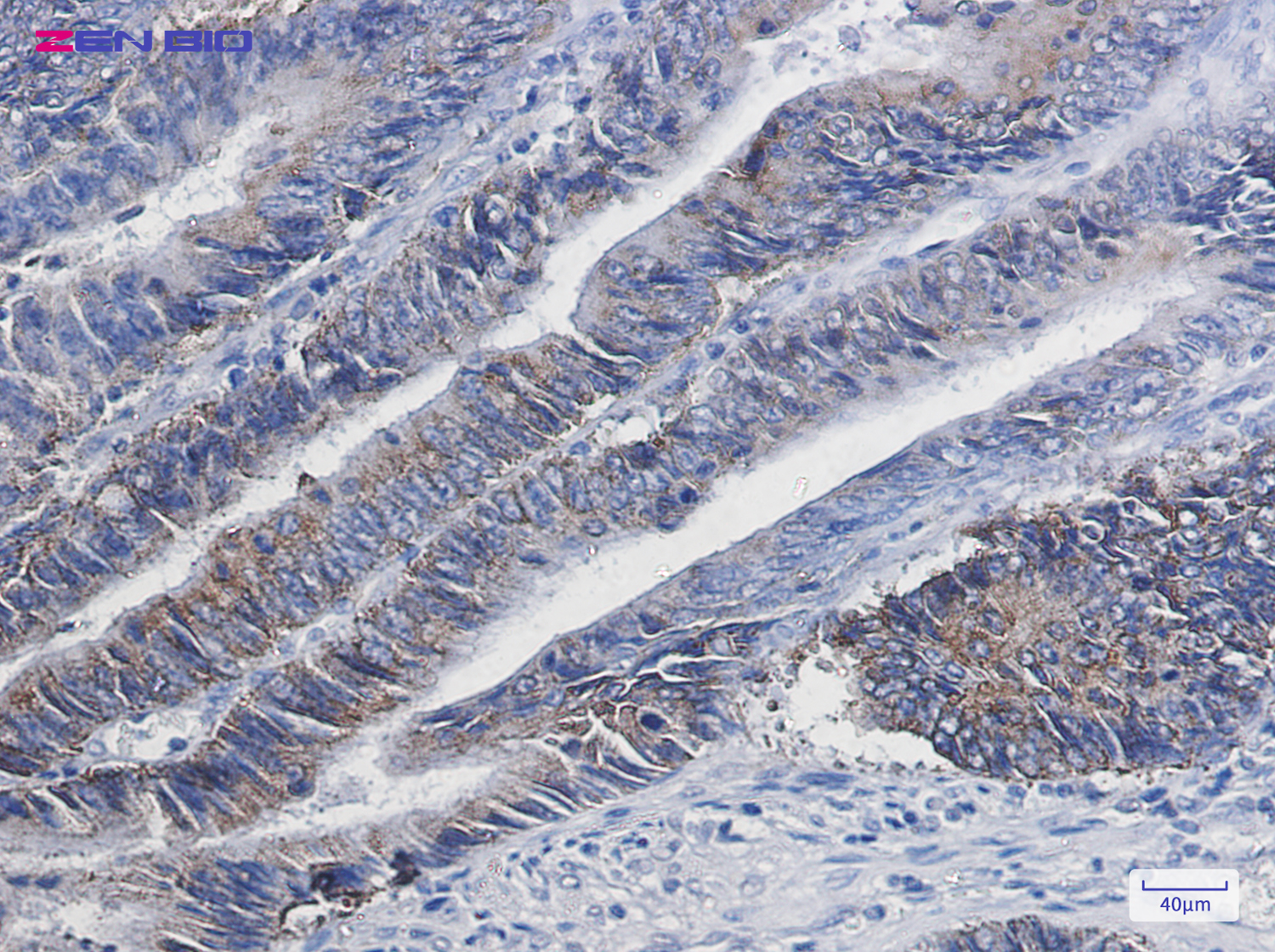 Immunohistochemistry of DGAT1 in paraffin-embedded Human colon cancer tissue using DGAT1 Rabbit pAb at dilution 1/20