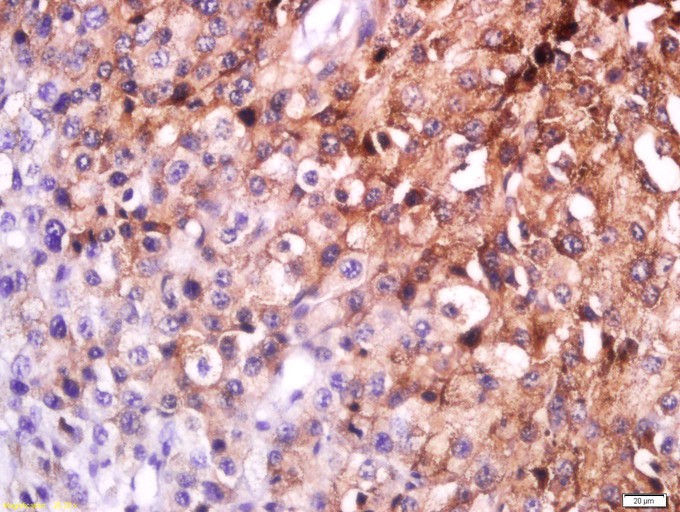 Fig3: Tissue/cell: human melanoma; 4% Paraformaldehyde-fixed and paraffin-embedded;; Antigen retrieval: citrate buffer ( 0.01M, pH 6.0 ), Boiling bathing for 15min; Block endogenous peroxidase by 3% Hydrogen peroxide for 30min; Blocking buffer (normal goat serum,C-0005) at 37℃ for 20 min;; Incubation: Anti-MSHR Polyclonal Antibody, Unconjugated 1:200, overnight at 4℃, followed by conjugation to the secondary antibody(SP-0023) and DAB(C-0010) staining