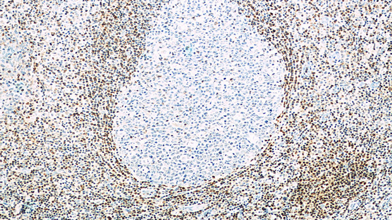 Immunohistochemistry of paraffin-embedded human tonsillitis tissue slide using Catalog No:107080(BCL2 Antibody) at dilution of 1:1000 (under 10x lens)