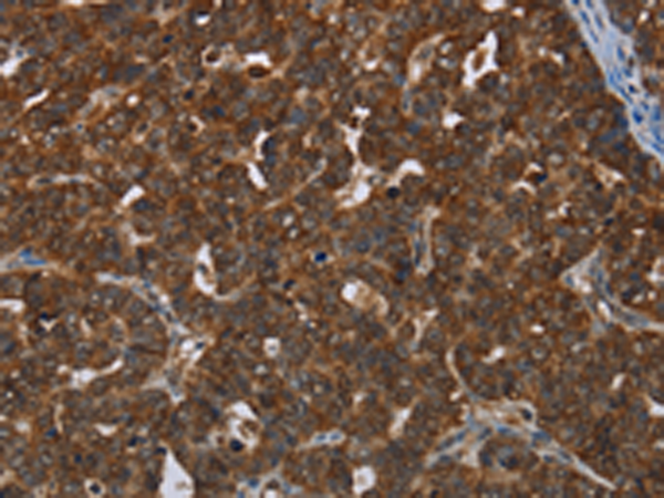 The image is immunohistochemistry of paraffin-embedded Human cervical cancer tissue using 166813(CERS5 Antibody) at dilution 1/35, on the right is treated with synthetic peptide. (Original magnification: ×200)