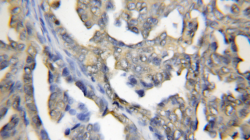 Immunohistochemical of paraffin-embedded human ovary tumor using Catalog No:114282(PRTFDC1 antibody) at dilution of 1:50 (under 10x lens)