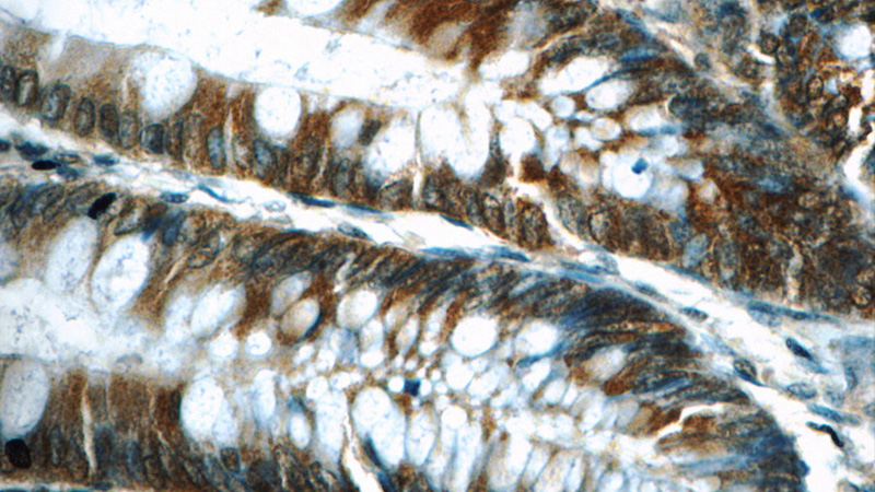 Immunohistochemistry of paraffin-embedded human colon tissue slide using Catalog No:110677(FKBP52 Antibody) at dilution of 1:50 (under 40x lens)