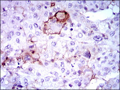 Fig3: Immunohistochemical analysis of paraffin-embedded human liver cancer tissue using anti- Lipoprotein a antibody. Counter stained with hematoxylin.