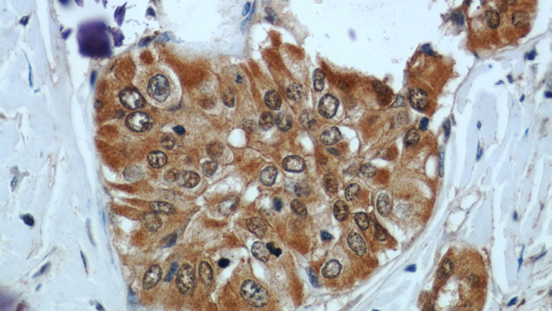 Immunohistochemical of paraffin-embedded human thyroid cancer using Catalog No:110840(Galectin 3 antibody) at dilution of 1:50 (under 40x lens)