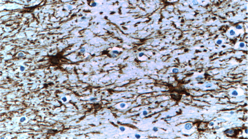 Immunohistochemistry of paraffin-embedded human brain tissue slide using Catalog No:107295(GFAP Antibody) at dilution of 1:5000 (under 40x lens). Heat mediated antigen retrieved with Citric acid buffer, pH6.0.