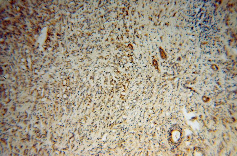 Immunohistochemical of paraffin-embedded human prostate cancer using Catalog No:115574(SPINT1 antibody) at dilution of 1:100 (under 10x lens)