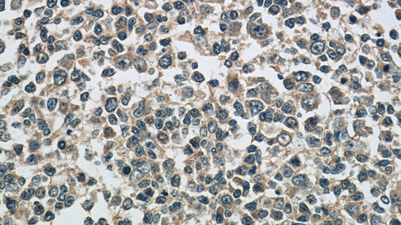 Immunohistochemistry of paraffin-embedded human tonsillitis tissue slide using Catalog No:108293(ATG2A Antibody) at dilution of 1:50 (under 40x lens)