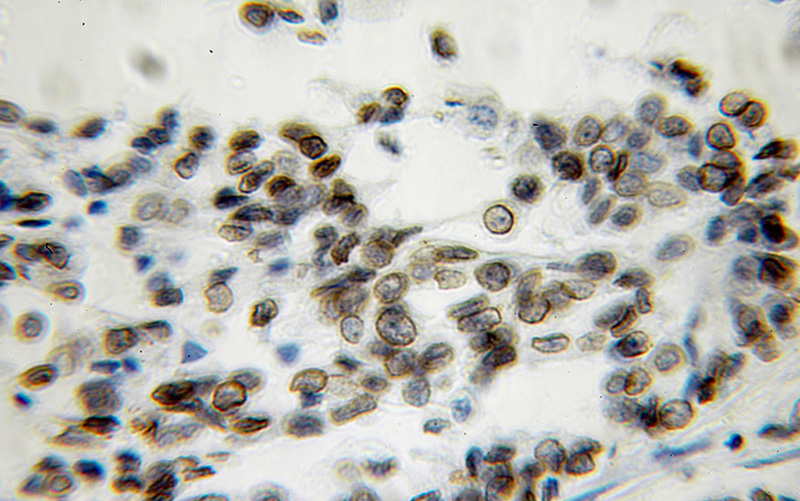 Immunohistochemical of paraffin-embedded human breast cancer using Catalog No:117329(LMNB1 antibody) at dilution of 1:100 (under 10x lens)