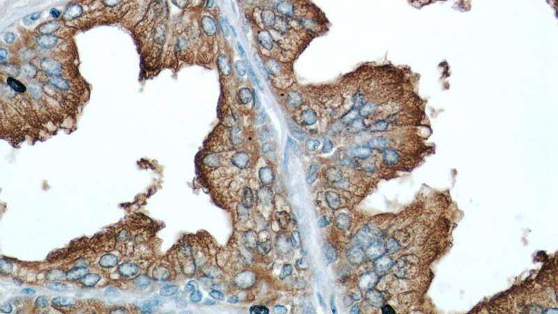Immunohistochemical of paraffin-embedded human prostate hyperplasia using Catalog No:107558(ACPP antibody) at dilution of 1:50 (under 40x lens)