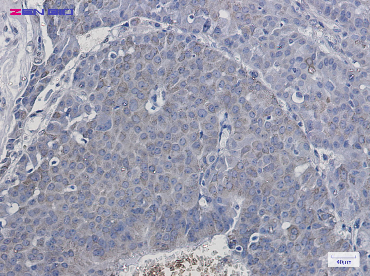 Immunohistochemistry of Creatine kinase B type in paraffin-embedded Human breast cancer tissue using Creatine kinase B type Rabbit pAb at dilution 1/50