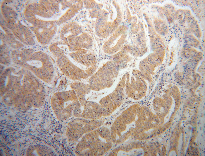 Immunohistochemical of paraffin-embedded human liver cancer using Catalog No:114734(RND3 antibody) at dilution of 1:50 (under 10x lens)