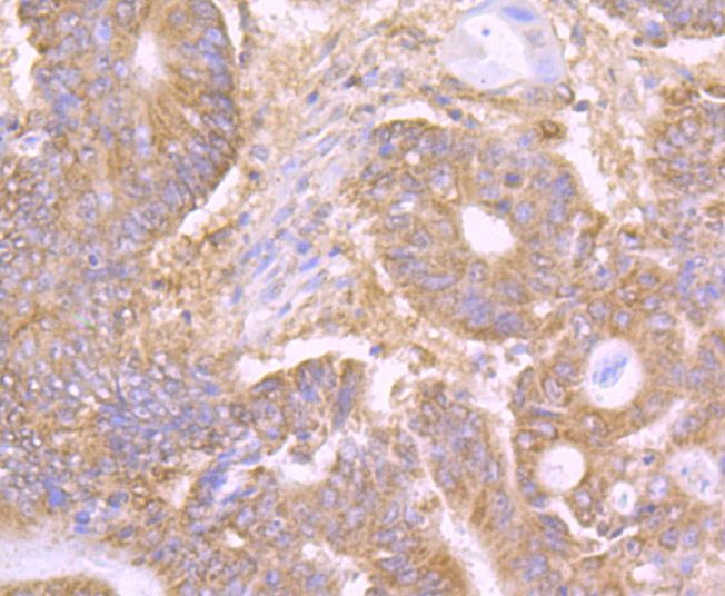Fig3:; Immunohistochemical analysis of paraffin-embedded human colon carcinoma tissue using anti-LY75 antibody. The section was pre-treated using heat mediated antigen retrieval with Tris-EDTA buffer (pH 9.0) for 20 minutes.The tissues were blocked in 1% BSA for 30 minutes at room temperature, washed with ddH; 2; O and PBS, and then probed with the primary antibody ( 1/50) for 30 minutes at room temperature. The detection was performed using an HRP conjugated compact polymer system. DAB was used as the chromogen. Tissues were counterstained with hematoxylin and mounted with DPX.
