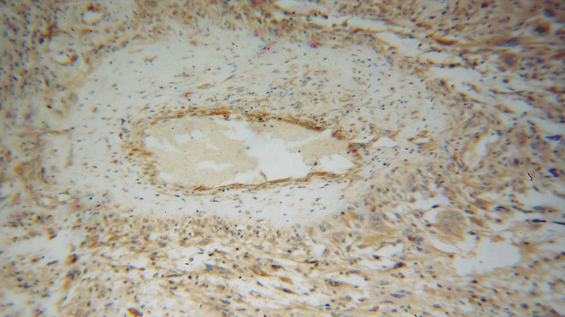 Immunohistochemical of paraffin-embedded human gliomas using Catalog No:113532(p115, USO1 antibody) at dilution of 1:100 (under 10x lens)