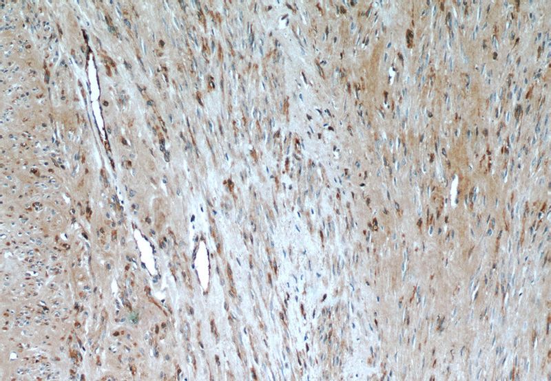 Immunohistochemistry of paraffin-embedded human hysteromyoma tissue slide using Catalog No:113530(OXTR Antibody) at dilution of 1:50 (under 10x lens)