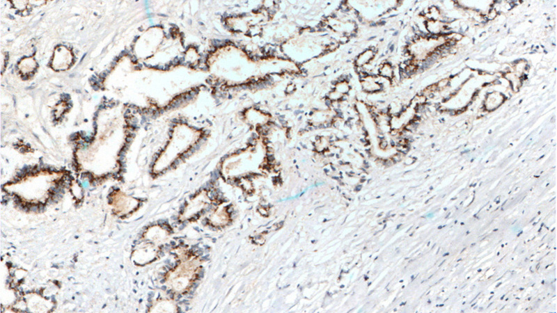 Immunohistochemistry of paraffin-embedded human pancreas cancer tissue slide using Catalog No:107378(IL10 Antibody) at dilution of 1:200 (under 10x lens). heat mediated antigen retrieved with Tris-EDTA buffer(pH9).