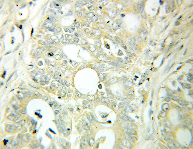 Immunohistochemical of paraffin-embedded human colon cancer using Catalog No:110282(ELMO2 antibody) at dilution of 1:100 (under 10x lens)
