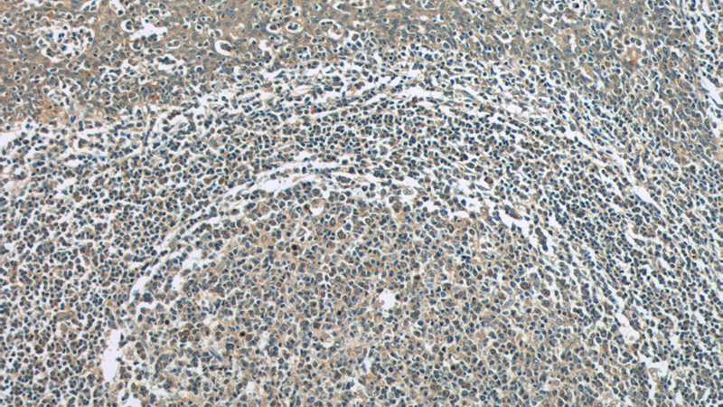 Immunohistochemistry of paraffin-embedded human tonsillitis tissue slide using Catalog No:113485(PLA2G7 Antibody) at dilution of 1:50 (under 10x lens)