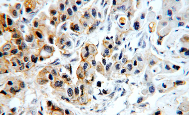 Immunohistochemical of paraffin-embedded human breast cancer using Catalog No:110346(EPCAM antibody) at dilution of 1:100 (under 40x lens)