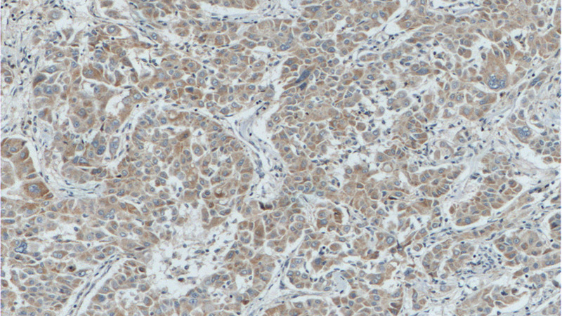 Immunohistochemistry of paraffin-embedded human liver cancer tissue slide using Catalog No:117100(BCL2L2 Antibody) at dilution of 1:200 (under 10x lens). heat mediated antigen retrieved with Tris-EDTA buffer(pH9).