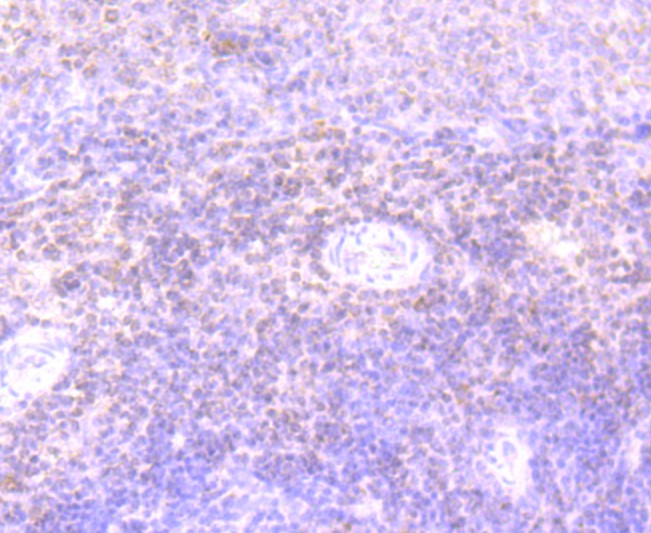 Fig6: Immunohistochemical analysis of paraffin-embedded human colon cancer tissue using anti-IL7 antibody. Counter stained with hematoxylin.