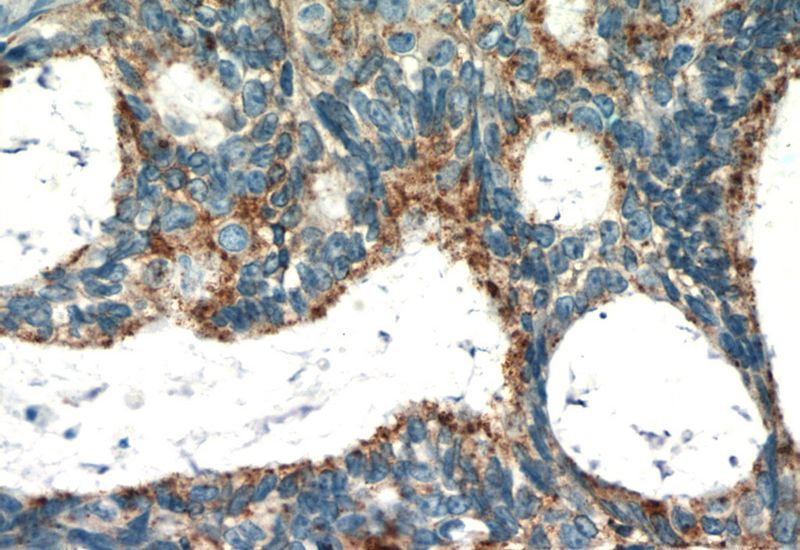 Immunohistochemistry of paraffin-embedded human ovary tumor slide using Catalog No:114479(RASGRP3 Antibody) at dilution of 1:50