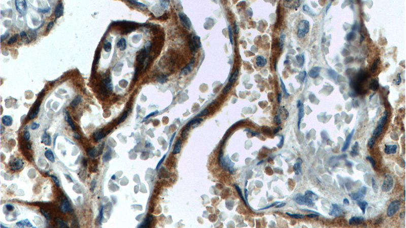 Immunohistochemistry of paraffin-embedded human placenta tissue slide using Catalog No:107151(CGB,hCG Antibody) at dilution of 1:1000 (under 40x lens). heat mediated antigen retrieved with Tris-EDTA buffer(pH9).