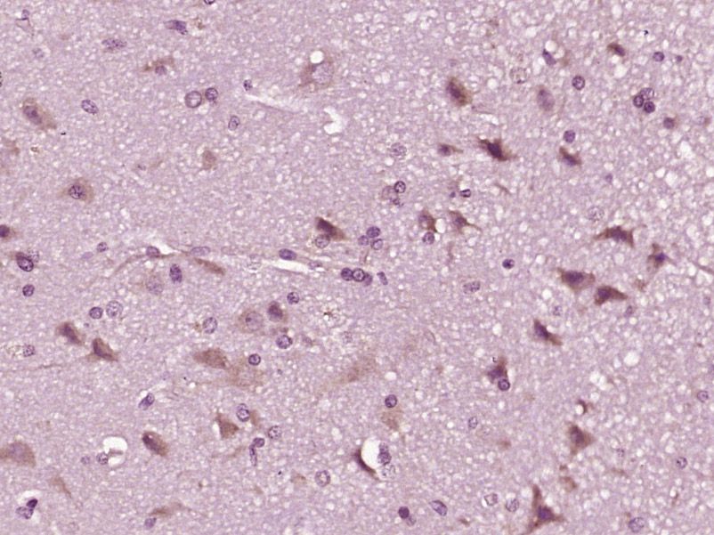 Fig3: Paraformaldehyde-fixed, paraffin embedded (human brain glioma); Antigen retrieval by boiling in sodium citrate buffer (pH6.0) for 15min; Block endogenous peroxidase by 3% hydrogen peroxide for 20 minutes; Blocking buffer (normal goat serum) at 37℃ for 30min; Antibody incubation with (CWH43) Polyclonal Antibody, Unconjugated at 1:400 overnight at 4℃, followed by operating according to SP Kit(Rabbit) (sp-0023) instructionsand DAB staining.
