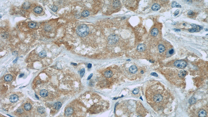 Immunohistochemistry of paraffin-embedded human breast cancer slide using Catalog No:114629(TRIM13 Antibody) at dilution of 1:50