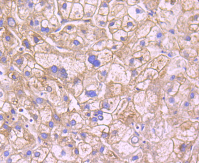 Fig5:; Immunohistochemical analysis of paraffin-embedded human liver carcinoma tissue using anti-Leptin Receptor antibody. The section was pre-treated using heat mediated antigen retrieval with Tris-EDTA buffer (pH 8.0-8.4) for 20 minutes.The tissues were blocked in 5% BSA for 30 minutes at room temperature, washed with ddH; 2; O and PBS, and then probed with the primary antibody ( 1/50) for 30 minutes at room temperature. The detection was performed using an HRP conjugated compact polymer system. DAB was used as the chromogen. Tissues were counterstained with hematoxylin and mounted with DPX.