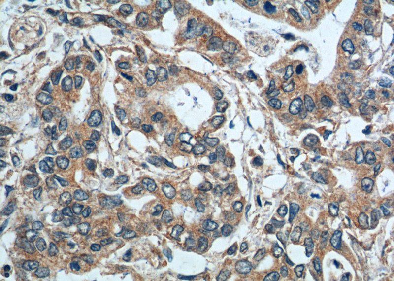 Immunohistochemistry of paraffin-embedded human pancreas cancer tissue slide using Catalog No:115173(SGSH Antibody) at dilution of 1:200 (under 40x lens).