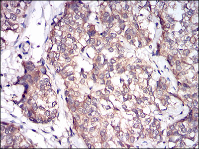 Immunohistochemical analysis of paraffin-embedded bladder cancer tissues using PRL mouse mAb with DAB staining.
