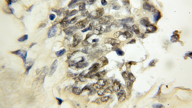 Immunohistochemical of paraffin-embedded human breast cancer using Catalog No:110153(E2F1 antibody) at dilution of 1:50 (under 10x lens)