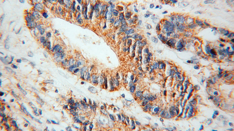 Immunohistochemical of paraffin-embedded human colon cancer using Catalog No:109543(CKB antibody) at dilution of 1:100 (under 40x lens)