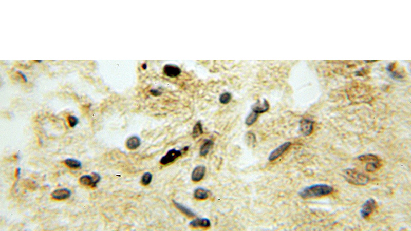 Immunohistochemical of paraffin-embedded human gliomas using Catalog No:116437(TSNAX antibody) at dilution of 1:50 (under 10x lens)