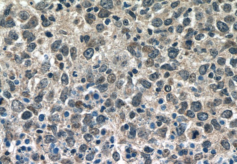 Immunohistochemistry of paraffin-embedded human lymphoma tissue slide using Catalog No:117101(BCL3 Antibody) at dilution of 1:50 (under 40x lens)