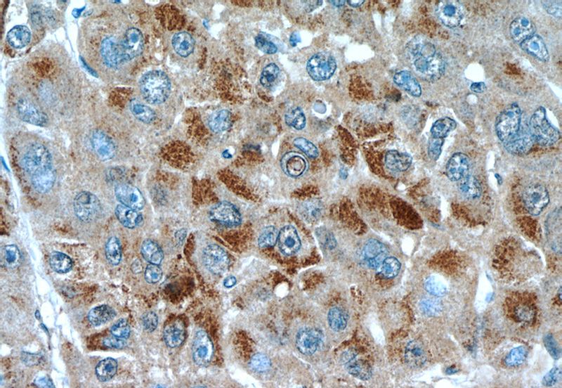 Immunohistochemistry of paraffin-embedded human liver cancer slide using Catalog No:110205(EFCAB5 Antibody) at dilution of 1:50