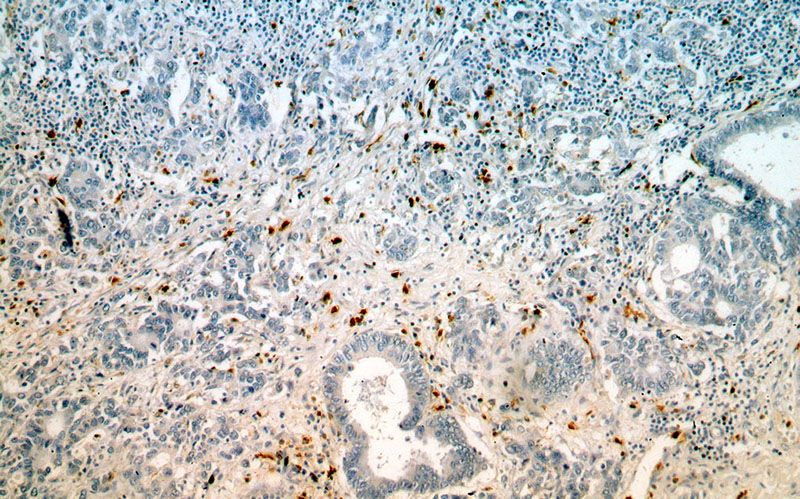 Immunohistochemical of paraffin-embedded human stomach cancer using Catalog No:114965(S100A8 antibody) at dilution of 1:100 (under 10x lens)