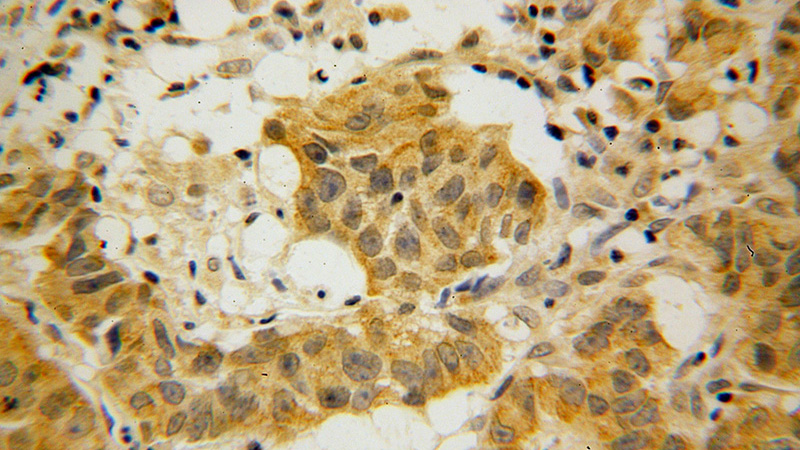 Immunohistochemical of paraffin-embedded human prostate cancer using Catalog No:116146(TNK1 antibody) at dilution of 1:100 (under 40x lens)