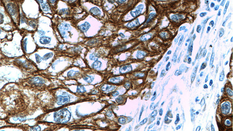 Immunohistochemistry of paraffin-embedded human lung cancer tissue slide using Catalog No:109792(KRT14 Antibody) at dilution of 1:200 (under 40x lens)