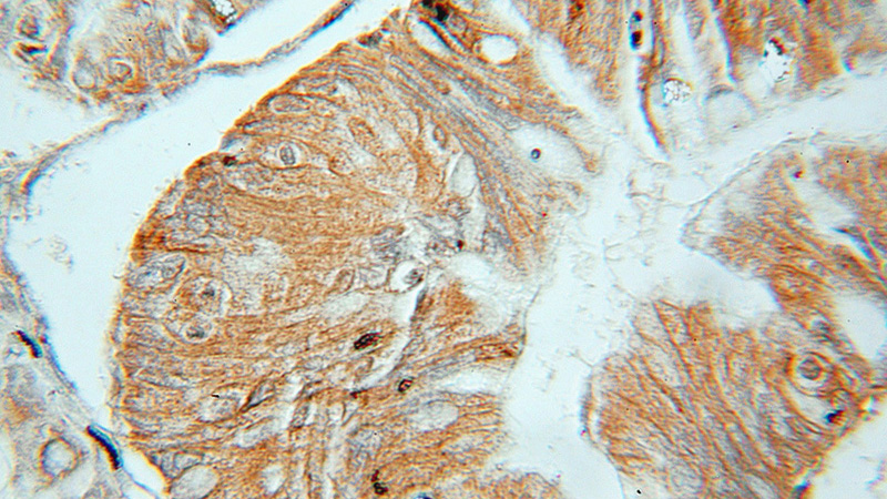 Immunohistochemical of paraffin-embedded human ovary tumor using Catalog No:113428(OSBP antibody) at dilution of 1:50 (under 10x lens)