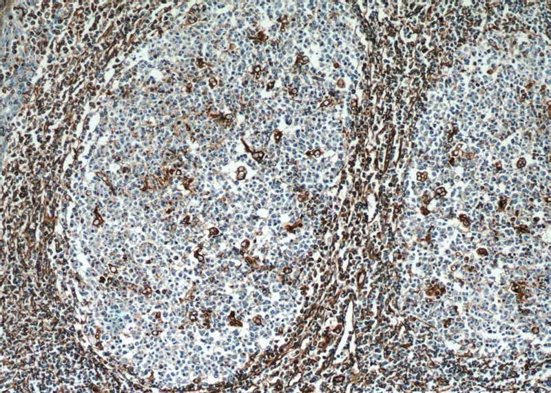 Immunohistochemical of paraffin-embedded human tonsillitis using Catalog No:116753(VIM antibody) at dilution of 1:50 (under 10x lens)