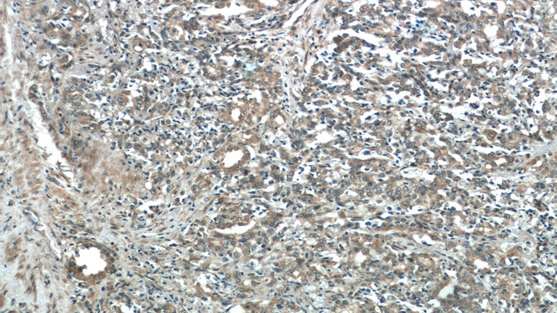 Immunohistochemistry of paraffin-embedded human prostate cancer tissue slide using Catalog No:109489(FAM36A Antibody) at dilution of 1:50 (under 10x lens)