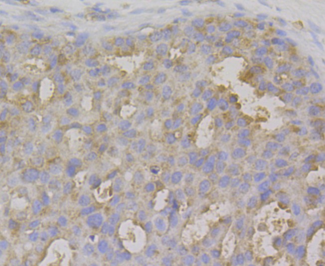 Fig4: Immunohistochemical analysis of paraffin-embedded human breasr cancer tissue using anti-IL-22 antibody. The section was pre-treated using heat mediated antigen retrieval with sodium citrate buffer (pH 6.0) for 20 minutes. The tissues were blocked in 5% BSA for 30 minutes at room temperature, washed with ddH2O and PBS, and then probed with the antibody at 1/200 dilution, for 30 minutes at room temperature and detected using an HRP conjugated compact polymer system. DAB was used as the chrogen. Counter stained with hematoxylin and mounted with DPX.