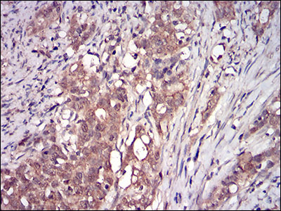 Immunohistochemical analysis of paraffin-embedded cervical cancer tissues using DDIT3 mouse mAb with DAB staining.