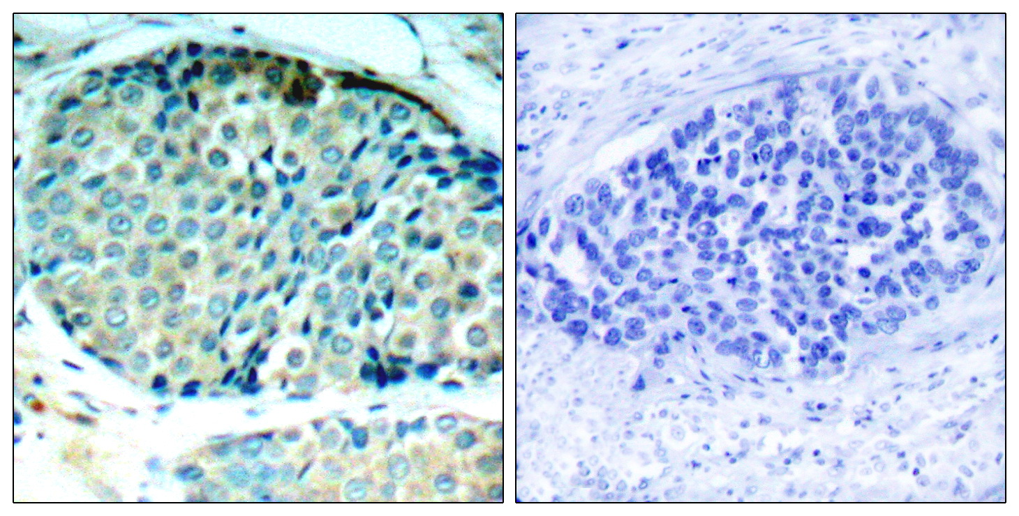 Immunohistochemical analysis of paraffin-embedded human breast carcinoma tissue using HSP27 (Phospho-Ser78) Antibody (left) or the same antibody preincubated with blocking peptide (right).